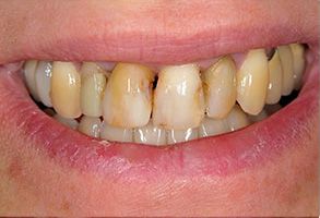 Gregory J. Schmitt, DMD | Dentures, Crowns amp Caps and Emergency Treatment